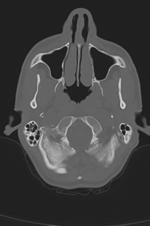 Anterior nasal spine fracture (Radiopaedia 46138-50494 Axial bone window 52).png