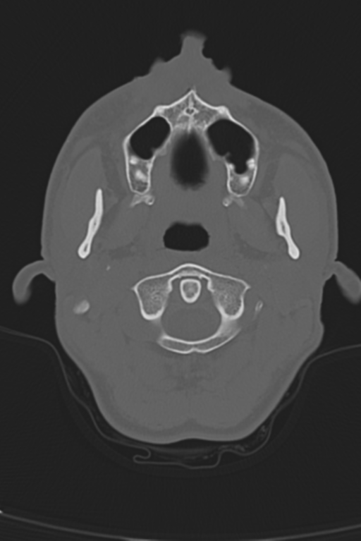 Anterior nasal spine fracture (Radiopaedia 46138-50494 Axial bone window 56).png
