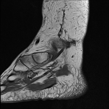 File:Anterior talofibular ligament injury - rupture with soft-tissue impingement (Radiopaedia 38765-40928 Sagittal PD 2).jpg