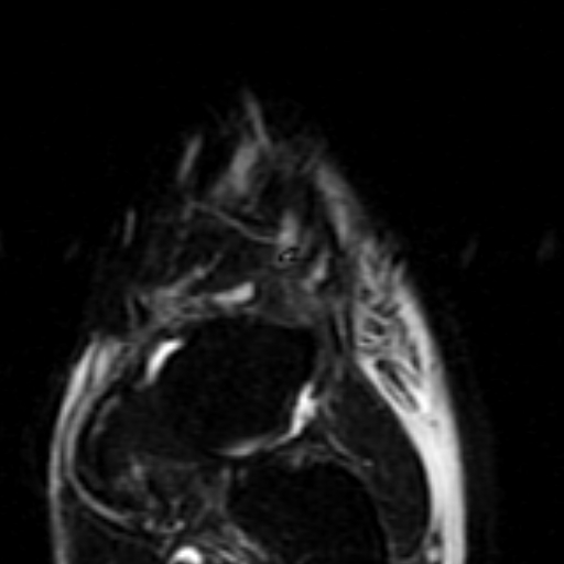 File:Anterior talofibular ligament rupture (Radiopaedia 15831-15484 Coronal STIR 3).jpg