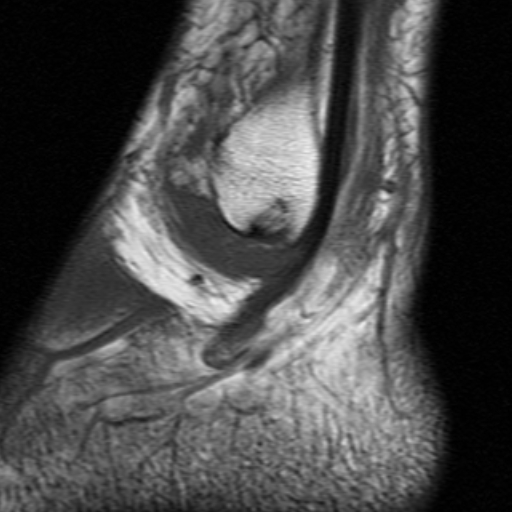 File:Anterior talofibular ligament rupture (Radiopaedia 15831-15484 Sagittal T1 3).jpg
