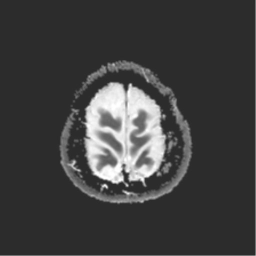 File:Anterior temporal lobe perivascular space (Radiopaedia 40946-43650 Axial ADC 26).png