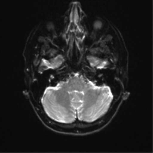 Anterior temporal lobe perivascular space (Radiopaedia 40946-43650 Axial DWI 5).png