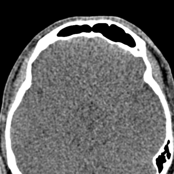 Antrochoanal polyp (Radiopaedia 30002-30554 Axial non-contrast 45).jpg