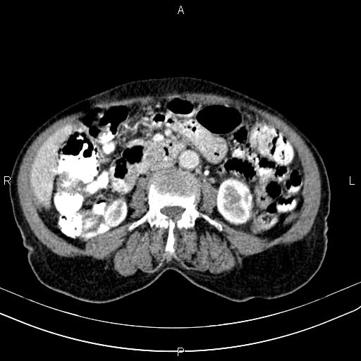 File:Aortic aneurysm and Lemmel syndrome (Radiopaedia 86499-102554 A 42).jpg