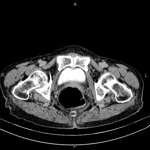 Aortic aneurysm and Lemmel syndrome (Radiopaedia 86499-102554 Axial C+ delayed 78).jpg