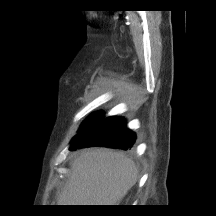 Aortic arch graft infection (FDG PET-CT) (Radiopaedia 71975-82437 C 7).jpg