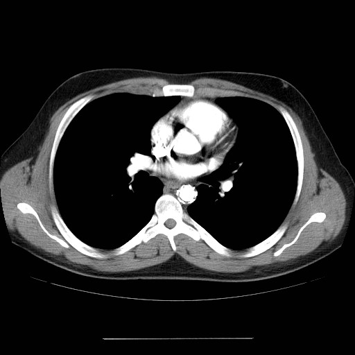 File:Aortic arch stent (Radiopaedia 30030-30595 D 19).jpg