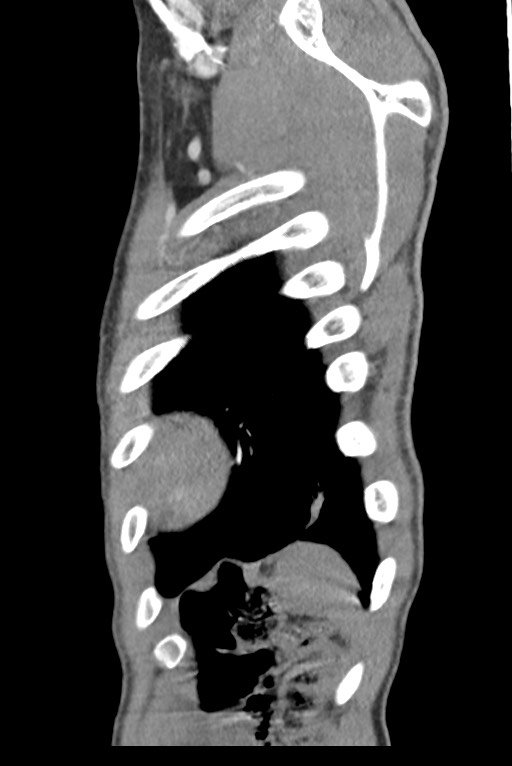 Aortic coarctation with aneurysm (Radiopaedia 74818-85828 B 142).jpg