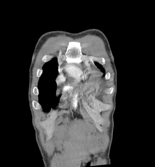 Aortic coarctation with aneurysm (Radiopaedia 74818-85828 C 14).jpg
