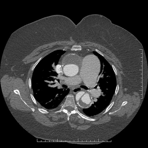 Aortic dissection- Stanford A (Radiopaedia 35729-37268 A 33).jpg