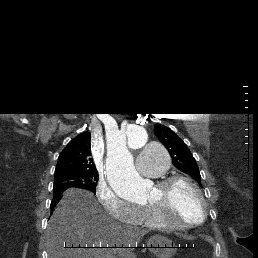 Aortic dissection- Stanford A (Radiopaedia 35729-37268 E 45).jpg