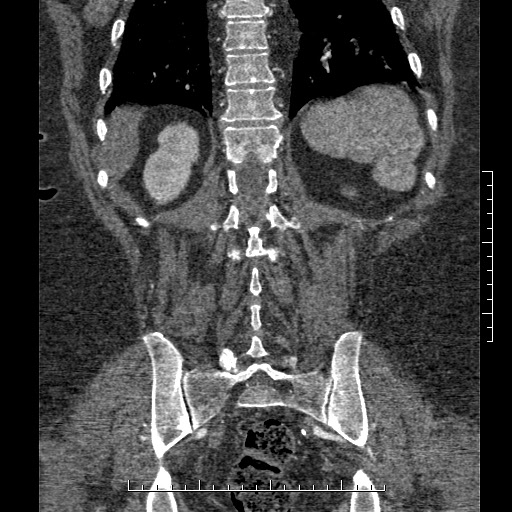 File:Aortic dissection- Stanford A (Radiopaedia 35729-37268 F 1).jpg