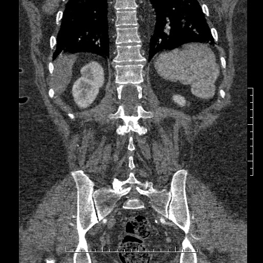 Aortic dissection- Stanford A (Radiopaedia 35729-37268 F 2).jpg