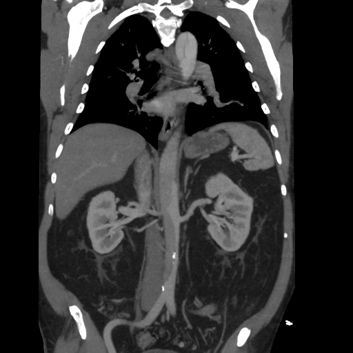 File:Aortic dissection- Stanford A (Radiopaedia 37759-39664 Coronal C+ delayed 29).png