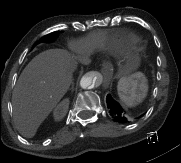 Aortic dissection (CTPA) (Radiopaedia 75506-86750 A 78).jpg