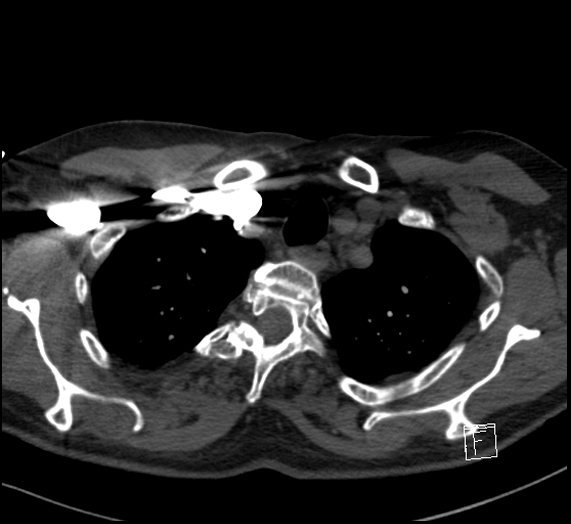 File:Aortic dissection (CTPA) (Radiopaedia 75506-86751 Axial C+ CTPA 23).jpg