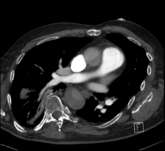 File:Aortic dissection (CTPA) (Radiopaedia 75506-86751 Axial C+ CTPA 72).jpg