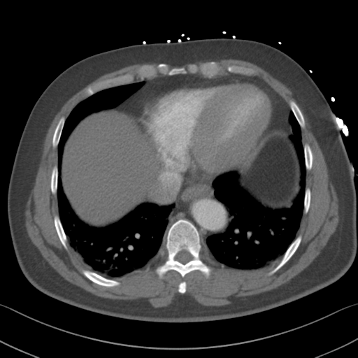Aortic dissection (Radiopaedia 50763-56234 A 55).png