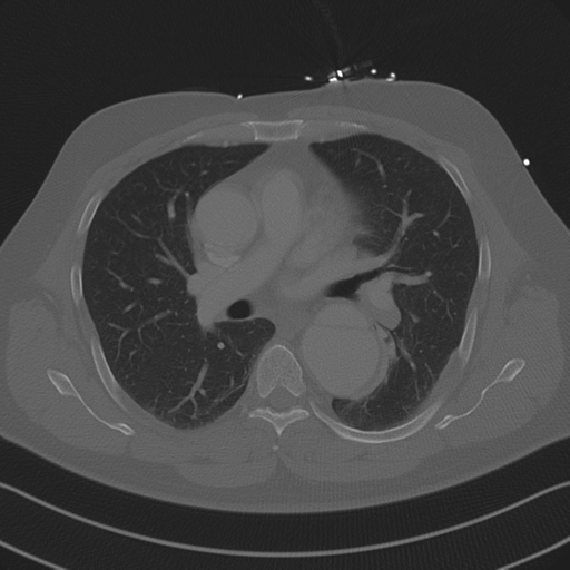 Aortic dissection (Radiopaedia 50763-56234 Axial bone window 51).png