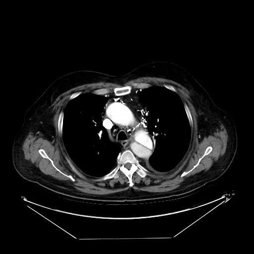 Aortic dissection (Radiopaedia 62562-71000 A 10).jpg