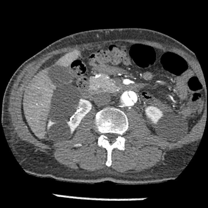 Aortic dissection - DeBakey Type I-Stanford A (Radiopaedia 79863-93115 A 52).jpg