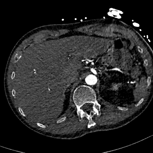 Aortic dissection - DeBakey type II (Radiopaedia 64302-73082 A 88).png