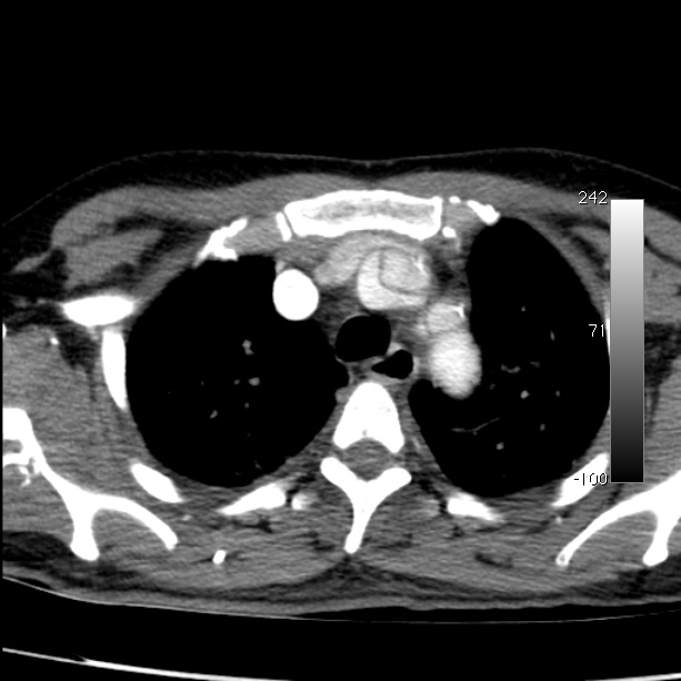 Aortic dissection - Stanford type A (Radiopaedia 29247-29659 A 18).jpg