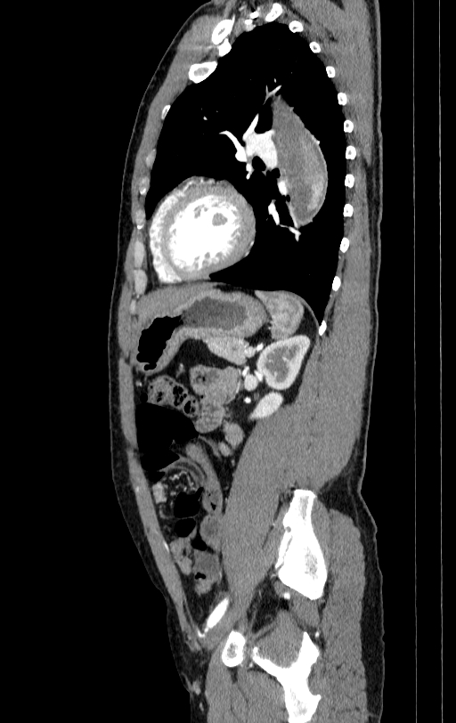 Aortic dissection - Stanford type A (Radiopaedia 83418-98500 B 66).jpg