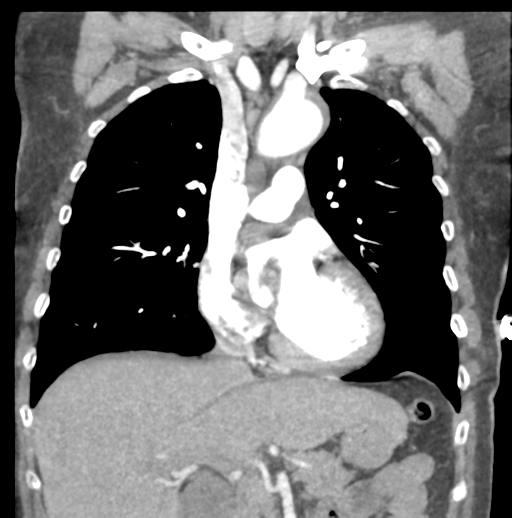 File:Aortic dissection - Stanford type B (Radiopaedia 50171-55512 B 36).png