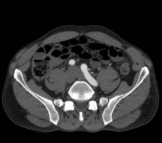 Aortic dissection - Stanford type B (Radiopaedia 73648-84437 A 207).jpg