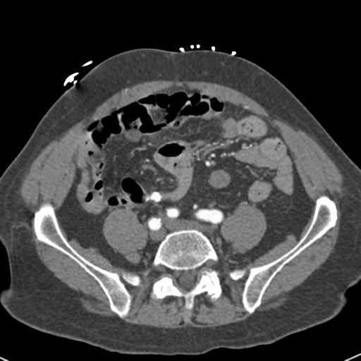 Aortic intramural hematoma (Radiopaedia 31139-31838 B 130).jpg