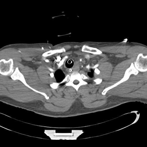 Aortic transection, diaphragmatic rupture and hemoperitoneum in a complex multitrauma patient (Radiopaedia 31701-32622 A 12).jpg