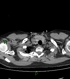 File:Aortic valve endocarditis (Radiopaedia 87209-103485 Axial non-contrast 13).jpg