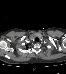 Aortic valve endocarditis (Radiopaedia 87209-103485 C 8).jpg