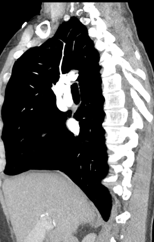 Aortic valve non-coronary cusp thrombus (Radiopaedia 55661-62189 C+ arterial phase 40).png