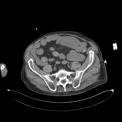 Aortoduodenal fistula (Radiopaedia 75286-86415 Axial non-contrast 53).jpg