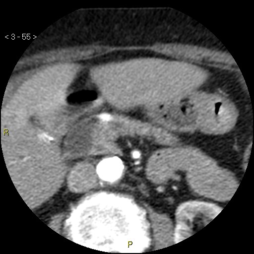 File:Aortoiliac occlusive disease (Radiopaedia 16828-16548 A 55).jpg