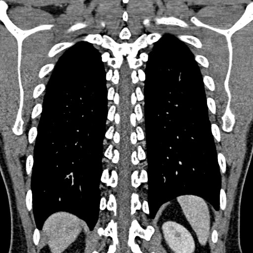 Apical lung mass mimic - neurogenic tumor (Radiopaedia 59918-67521 B 85).jpg