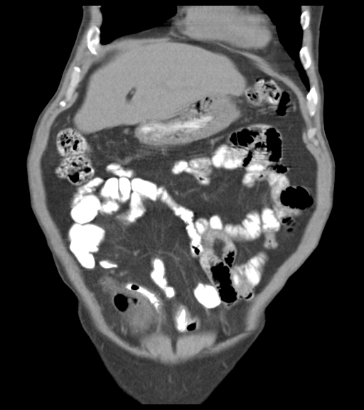 File:Appendiceal abscesses (Radiopaedia 50999-56542 Coronal non-contrast 18).png