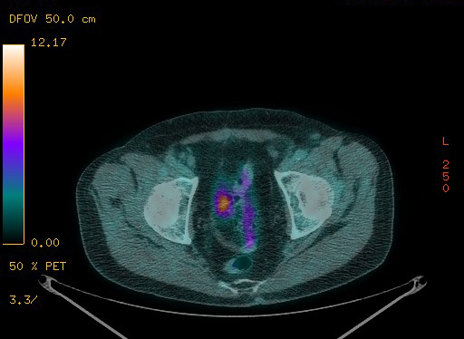 Appendiceal adenocarcinoma complicated by retroperitoneal abscess (Radiopaedia 58007-65041 Axial PET-CT 181).jpg