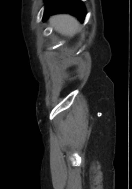 Appendicitis due to chicken fibula (Radiopaedia 74314-85198 C 6).jpg