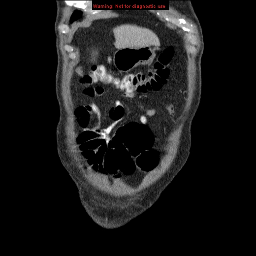 File:Appendicitis mass in inguinal hernia (Radiopaedia 26858-27029 B 5).jpg