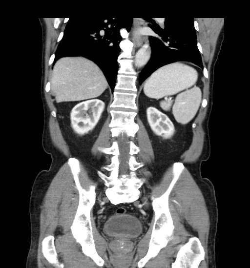 File:Appendicitis with localized perforation and abscess formation (Radiopaedia 49035-54130 B 34).jpg