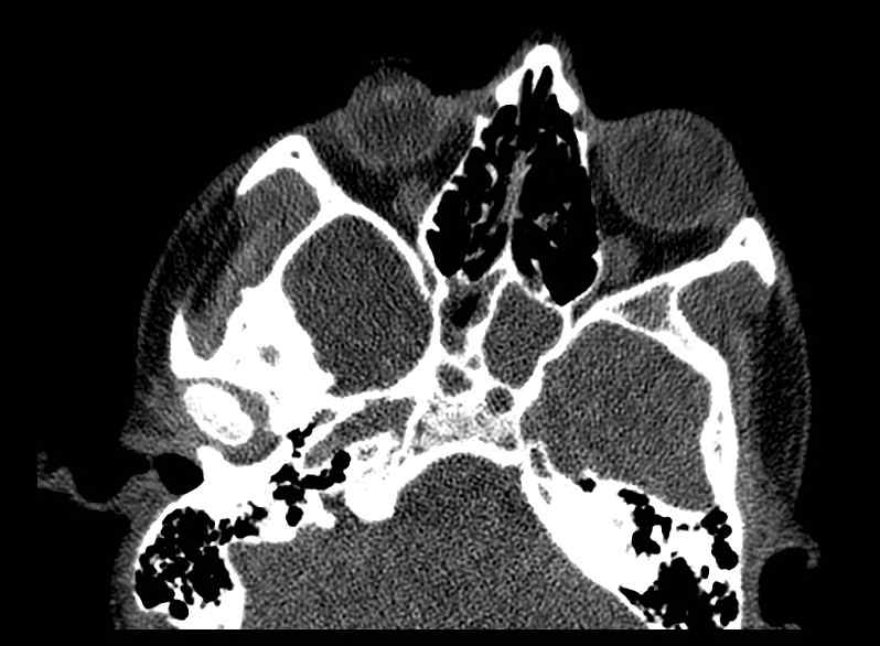 Arachnoid cyst- extremely large (Radiopaedia 68741-78450 Axial bone window 11).jpg