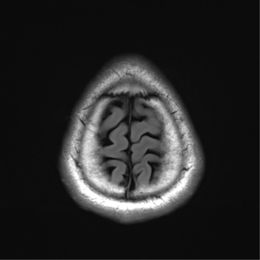 File:Arachnoid cyst - cerebellopontine angle (Radiopaedia 59689-67083 Axial FLAIR 35).png