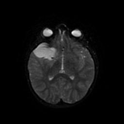 Arachnoid cyst - middle cranial fossa (Radiopaedia 67671-77088 Axial DWI 40).jpg