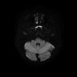 Arachnoid cyst - middle cranial fossa (Radiopaedia 67671-77088 Axial DWI 7).jpg