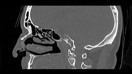 Arcuate foramen (Radiopaedia 89833-106944 Sagittal bone window 40).jpg