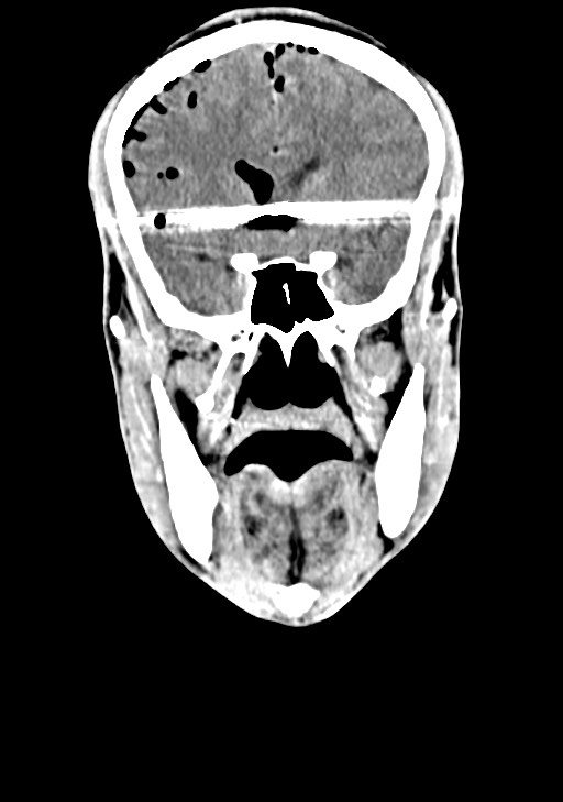 Arrow injury to the brain (Radiopaedia 72101-82607 Coronal non-contrast 32).jpg